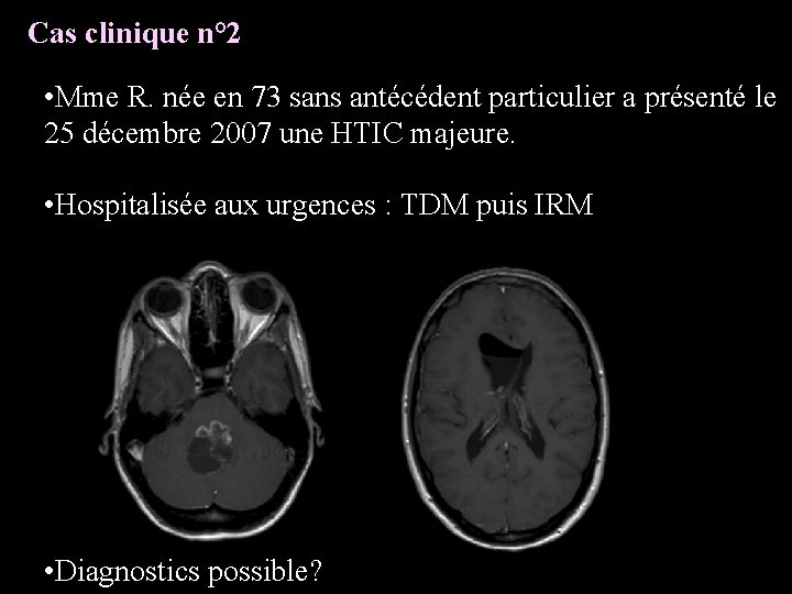 Cas clinique n° 2 • Mme R. née en 73 sans antécédent particulier a