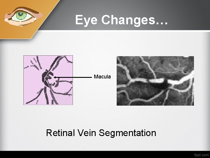 Eye Changes… Macula Retinal Vein Segmentation 