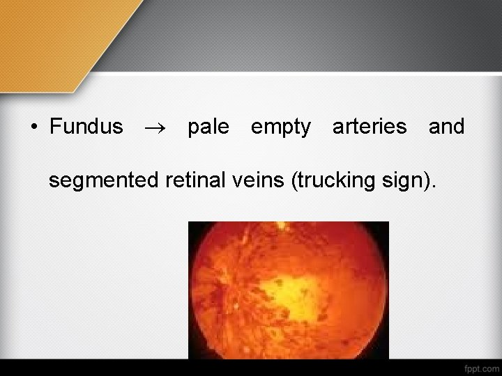  • Fundus pale empty arteries and segmented retinal veins (trucking sign). 