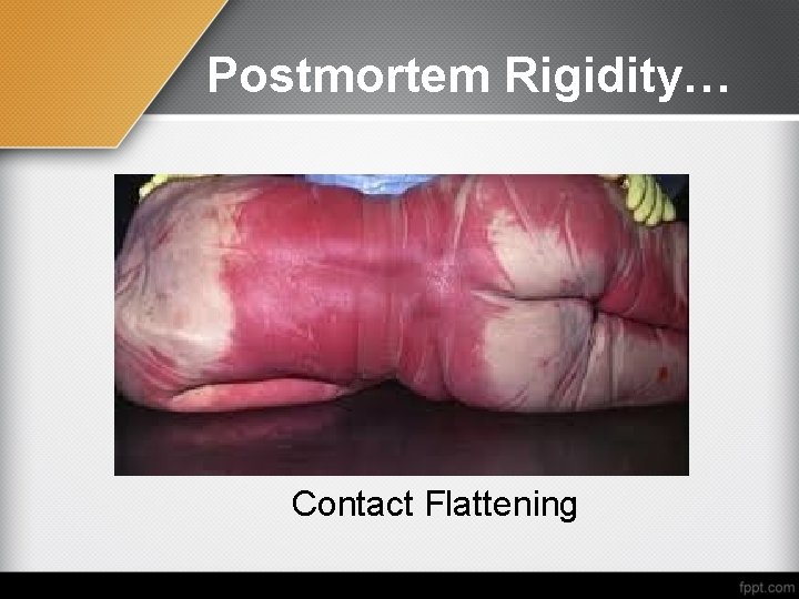 Postmortem Rigidity… Contact Flattening 