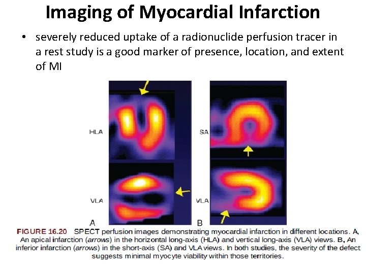 Imaging of Myocardial Infarction • severely reduced uptake of a radionuclide perfusion tracer in