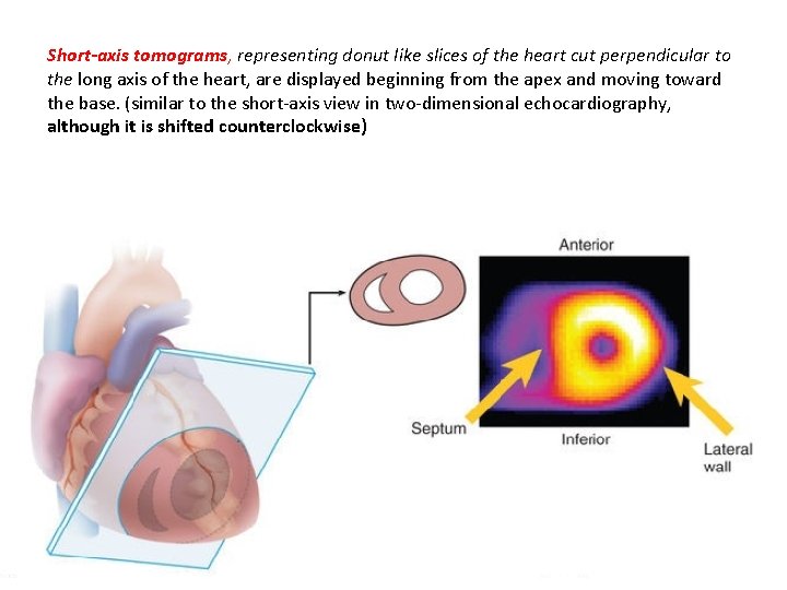 Short-axis tomograms, representing donut like slices of the heart cut perpendicular to the long
