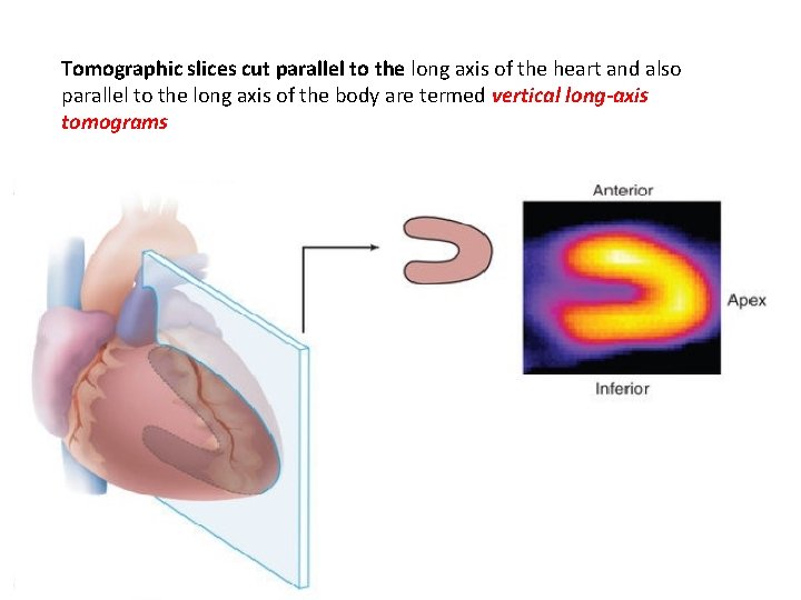 Tomographic slices cut parallel to the long axis of the heart and also parallel