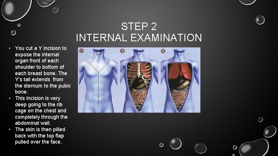 STEP 2 INTERNAL EXAMINATION • You cut a Y incision to expose the internal