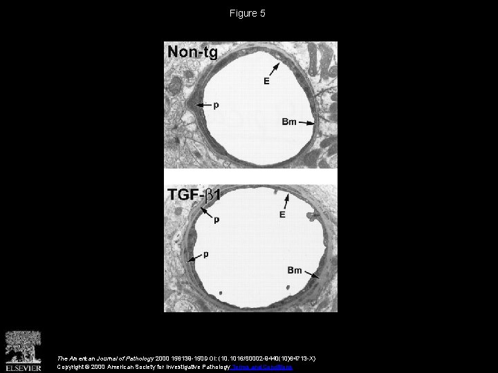 Chronic Overproduction of Transforming Growth Factor 1 by