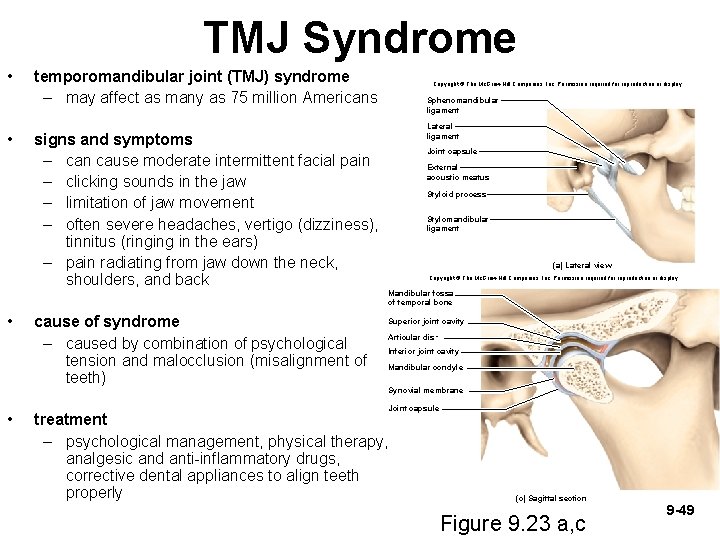 TMJ Syndrome • • temporomandibular joint (TMJ) syndrome – may affect as many as
