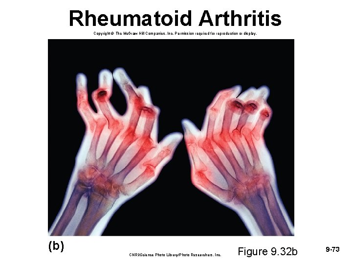 Rheumatoid Arthritis Copyright © The Mc. Graw-Hill Companies, Inc. Permission required for reproduction or