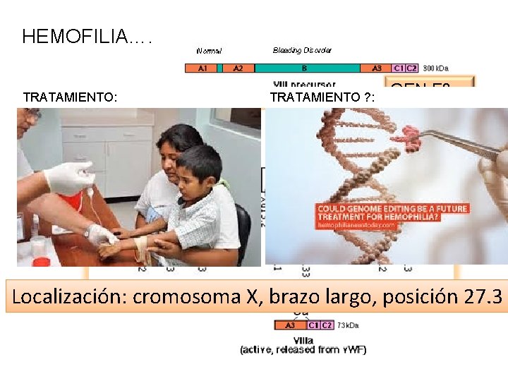 HEMOFILIA…. TRATAMIENTO: TRATAMIENTO ? : GEN F 8 Localización: cromosoma X, brazo largo, posición