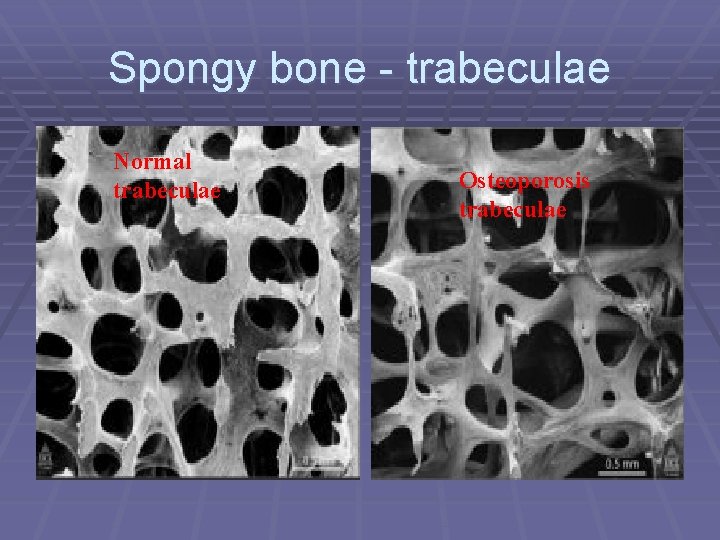 Spongy bone - trabeculae Normal trabeculae Osteoporosis trabeculae 