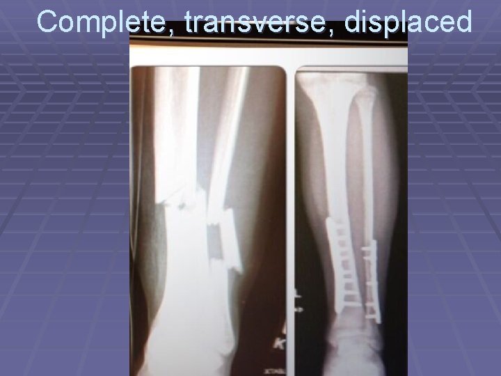 Complete, transverse, displaced 