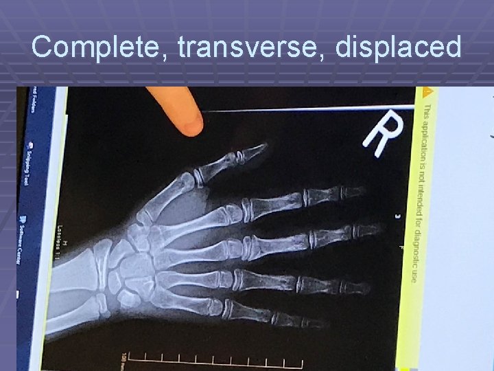 Complete, transverse, displaced 