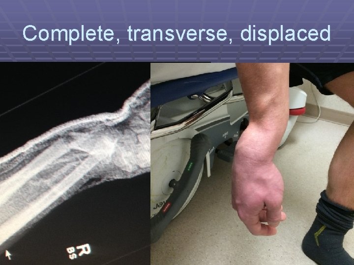 Complete, transverse, displaced 