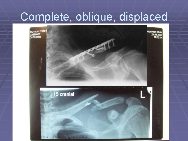 Complete, oblique, displaced 