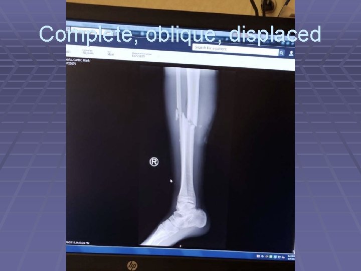 Complete, oblique, displaced 