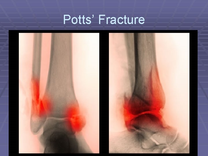 Potts’ Fracture 