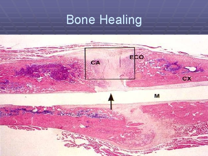 Bone Healing 