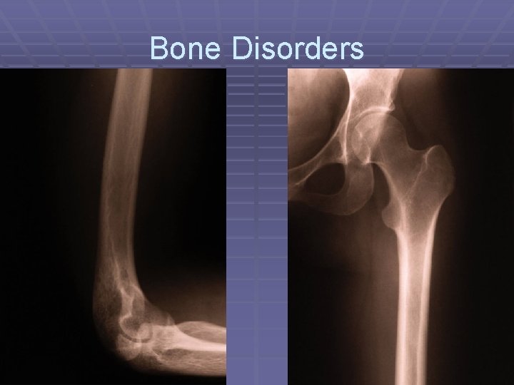 Bone Disorders 
