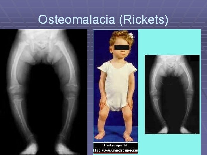 Osteomalacia (Rickets) 