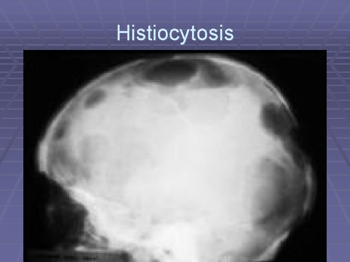 Histiocytosis 