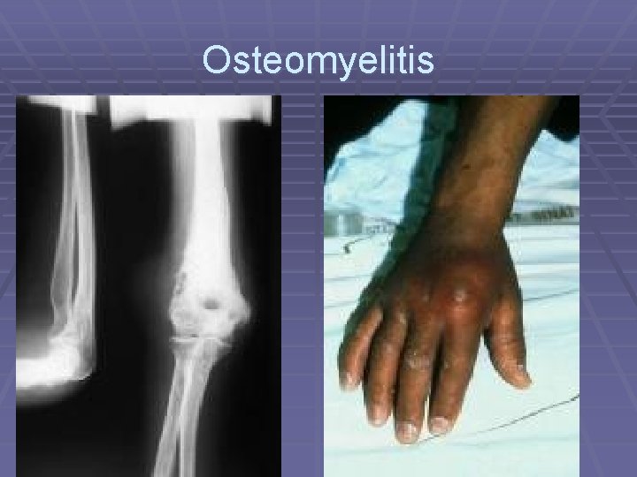 Osteomyelitis 