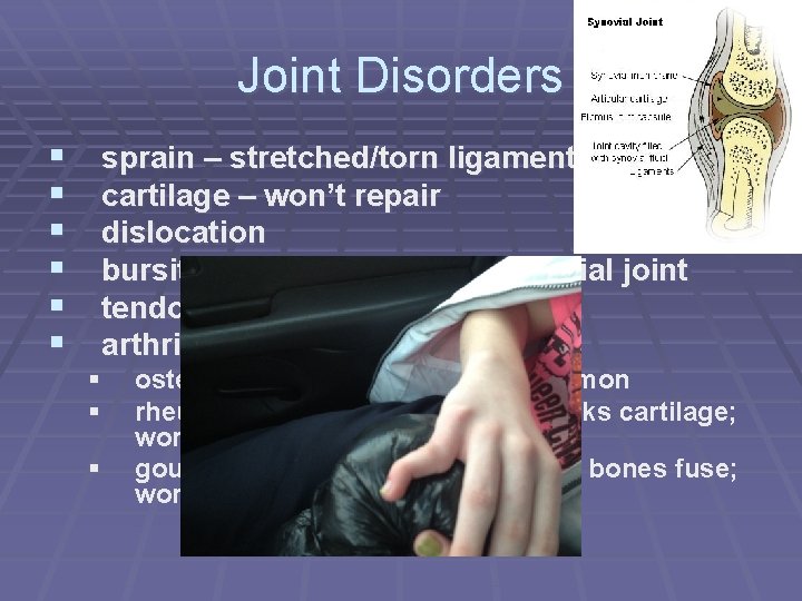 Joint Disorders § § § sprain – stretched/torn ligament cartilage – won’t repair dislocation