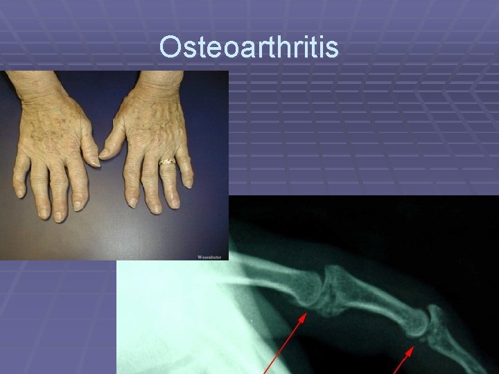 Osteoarthritis 