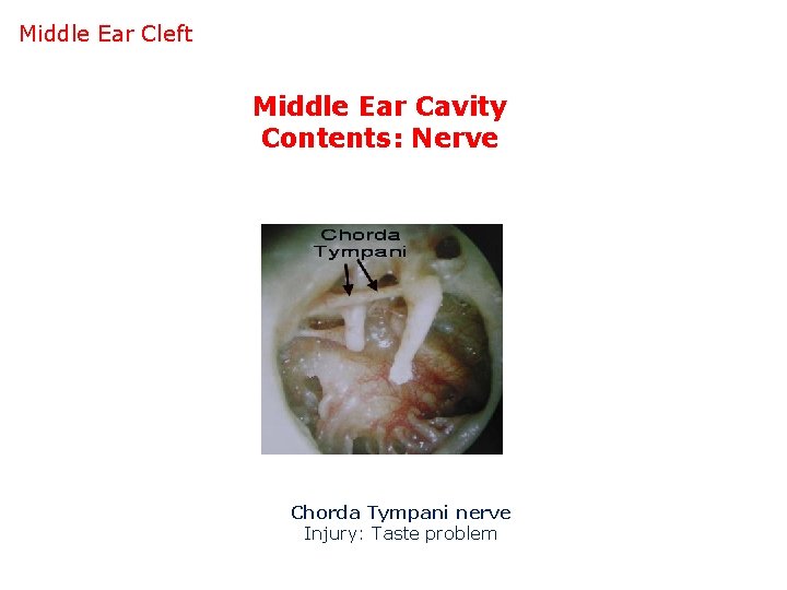 Middle Ear Cleft Middle Ear Cavity Contents: Nerve Chorda Tympani nerve Injury: Taste problem