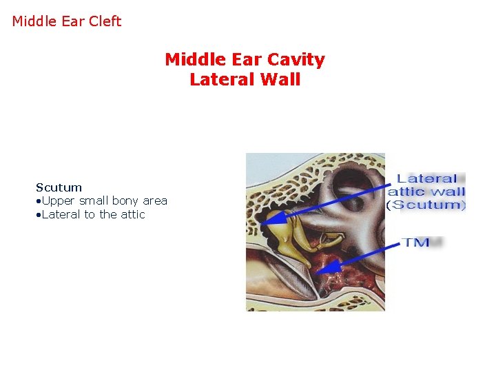 Middle Ear Cleft Middle Ear Cavity Lateral Wall Scutum • Upper small bony area