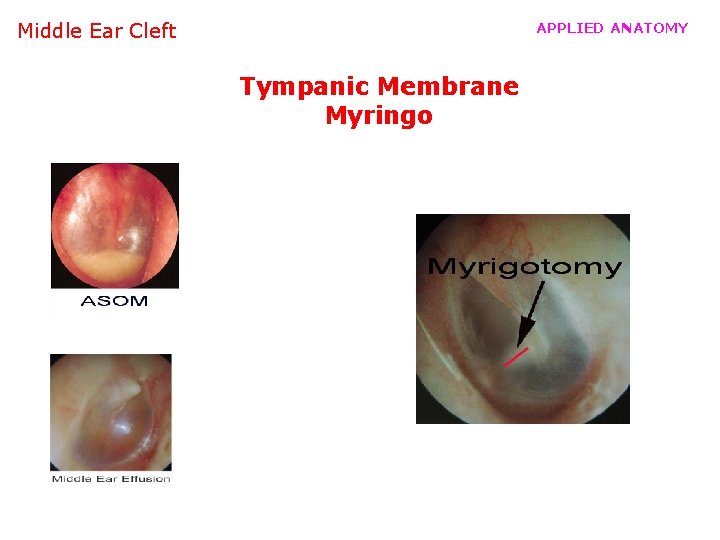 Middle Ear Cleft APPLIED ANATOMY Tympanic Membrane Myringo 