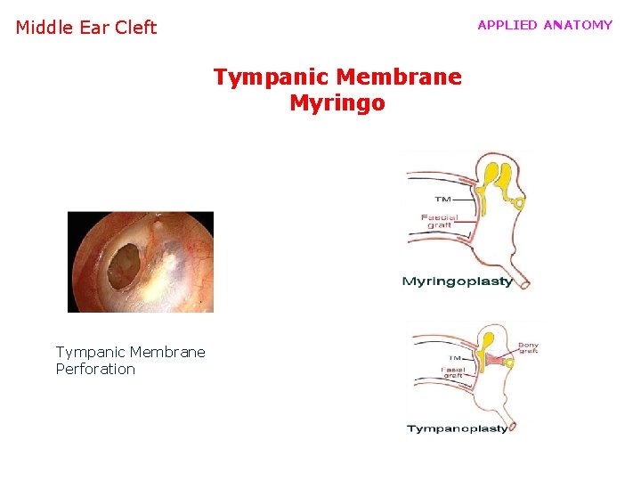 Middle Ear Cleft APPLIED ANATOMY Tympanic Membrane Myringo Tympanic Membrane Perforation 
