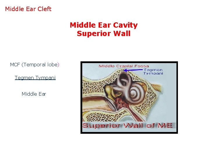Middle Ear Cleft Middle Ear Cavity Superior Wall MCF (Temporal lobe) Tegmen Tympani Middle