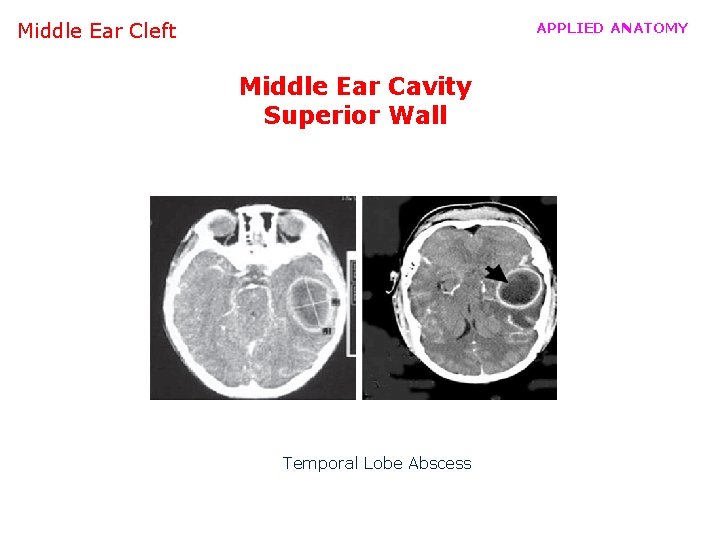 Middle Ear Cleft APPLIED ANATOMY Middle Ear Cavity Superior Wall Temporal Lobe Abscess 