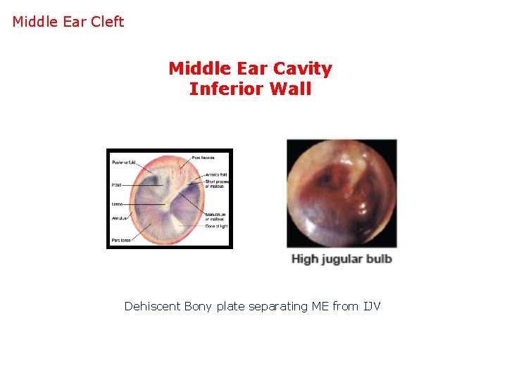 Middle Ear Cleft Middle Ear Cavity Inferior Wall Dehiscent Bony plate separating ME from