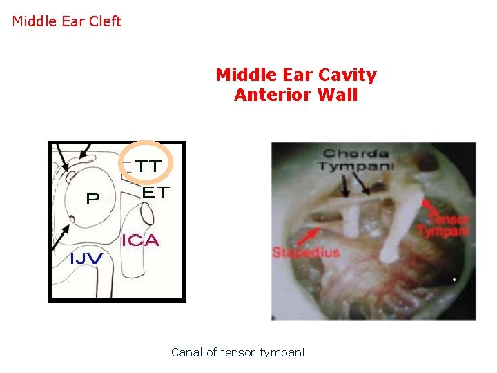 Middle Ear Cleft M Middle Ear Cavity Anterior Wall Canal of tensor tympani 