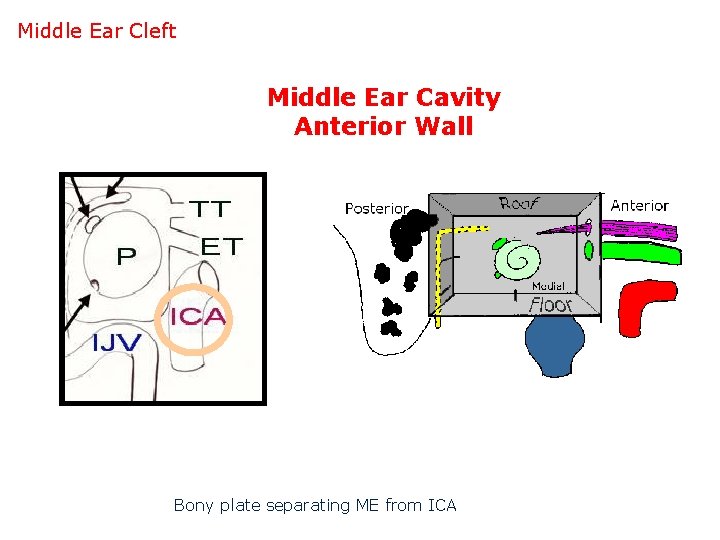 Middle Ear Cleft Middle Ear Cavity Anterior Wall Bony plate separating ME from ICA