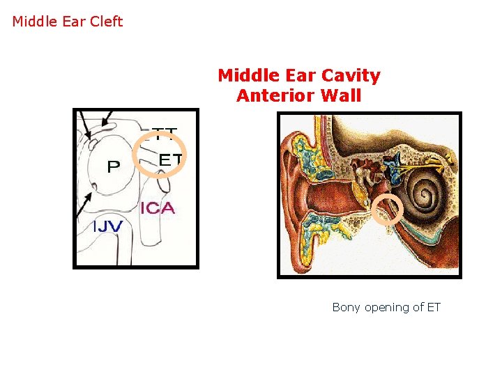 Middle Ear Cleft Middle Ear Cavity Anterior Wall Bony opening of ET 