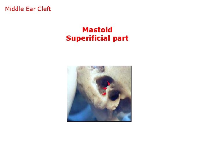 Middle Ear Cleft Mastoid Superificial part 