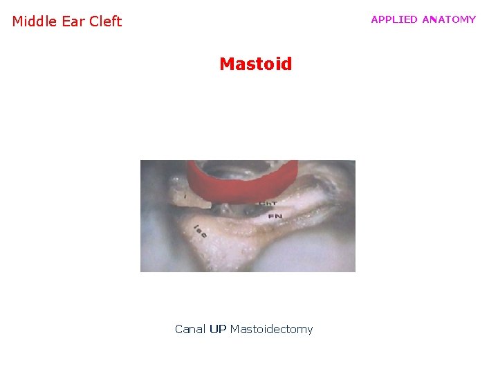 Middle Ear Cleft APPLIED ANATOMY Mastoid Canal UP Mastoidectomy 