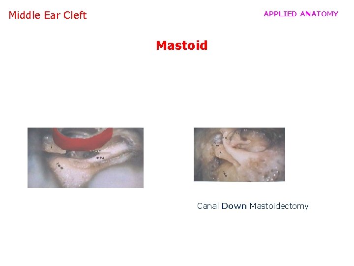 Middle Ear Cleft APPLIED ANATOMY Mastoid Canal Down Mastoidectomy 