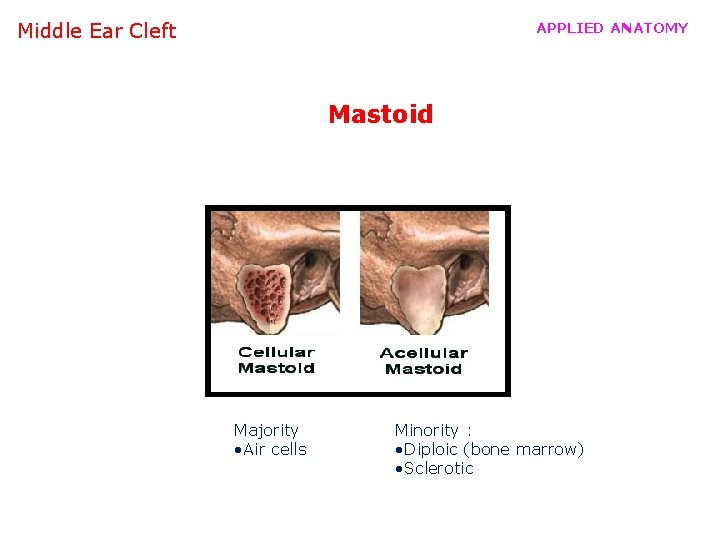Middle Ear Cleft APPLIED ANATOMY Mastoid Majority • Air cells Minority : • Diploic