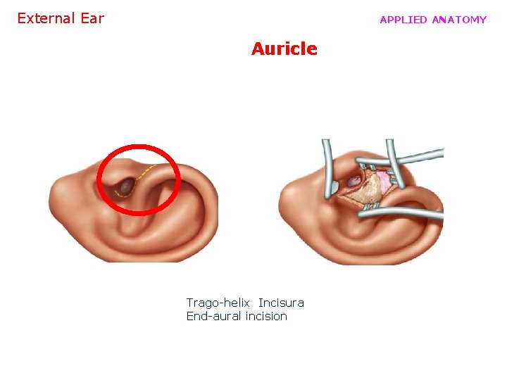 External Ear APPLIED ANATOMY Auricle Trago-helix Incisura End-aural incision 