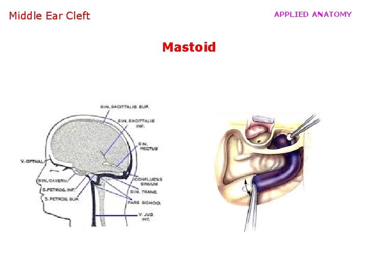 Middle Ear Cleft APPLIED ANATOMY Mastoid 