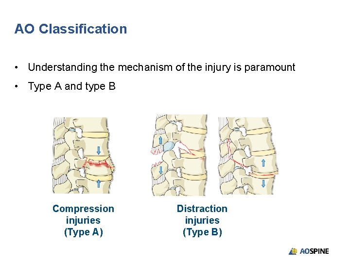 AO Classification • Understanding the mechanism of the injury is paramount • Type A