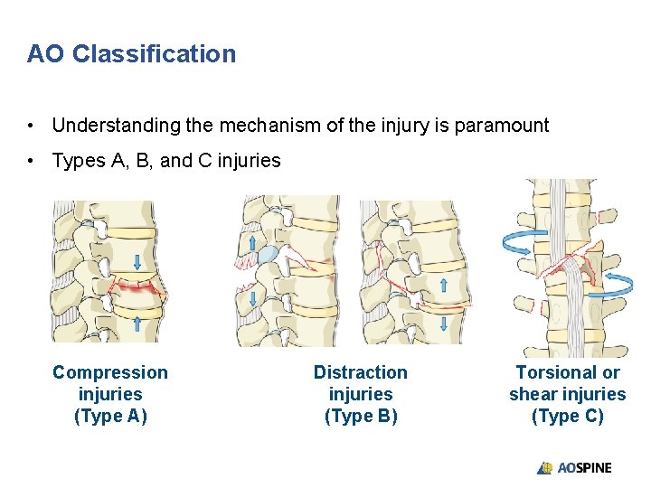 AO Classification • Understanding the mechanism of the injury is paramount • Types A,