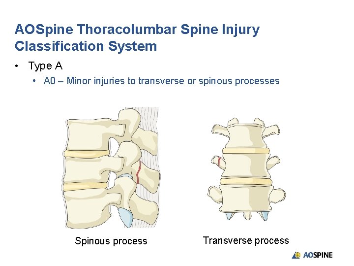 AOSpine Thoracolumbar Spine Injury Classification System • Type A • A 0 – Minor