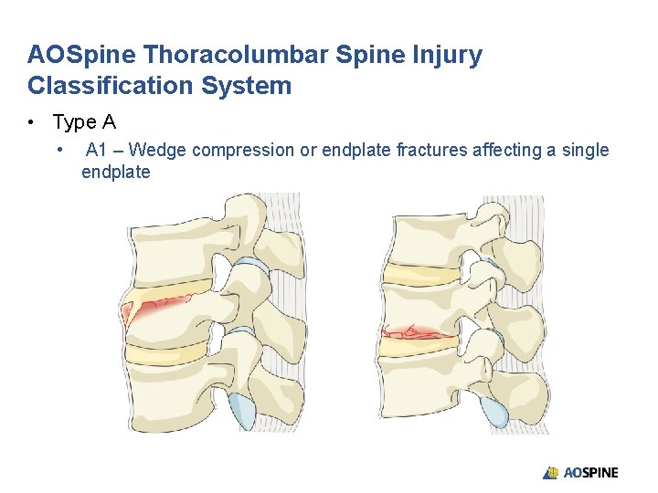 AOSpine Thoracolumbar Spine Injury Classification System • Type A • A 1 – Wedge