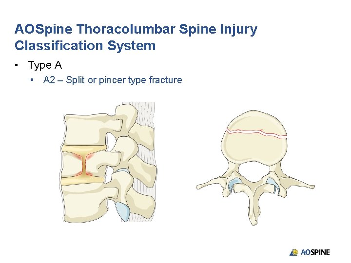 AOSpine Thoracolumbar Spine Injury Classification System • Type A • A 2 – Split