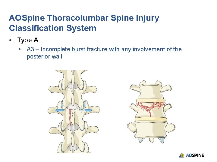 AOSpine Thoracolumbar Spine Injury Classification System • Type A • A 3 – Incomplete