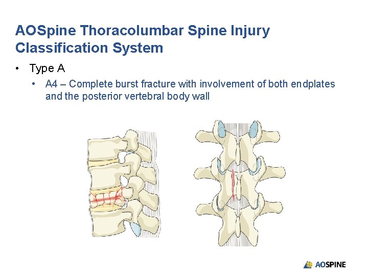 AOSpine Thoracolumbar Spine Injury Classification System • Type A • A 4 – Complete