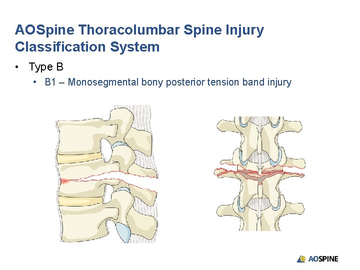 AOSpine Thoracolumbar Spine Injury Classification System • Type B • B 1 – Monosegmental